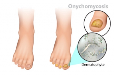 Signs of Improved Toenail Fungus