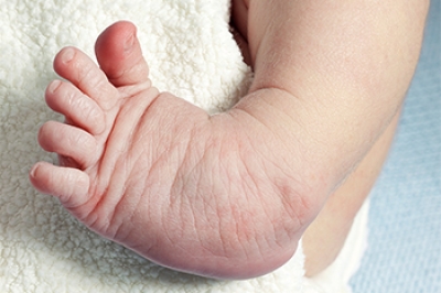 Definition and Causes of Idiopathic Congenital Clubfoot: