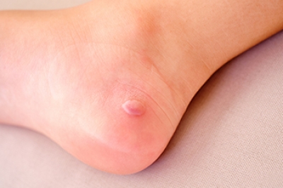 Causes and Prevention of Friction Blisters